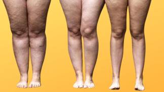 lipedema-2